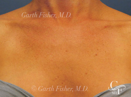 Photo of Patient 05 After Skin/Laser Treatments