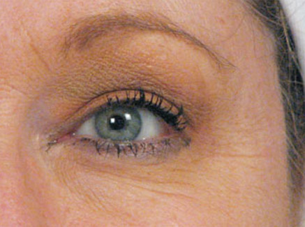 Photo of Patient 06 Before Skin/Laser Treatments