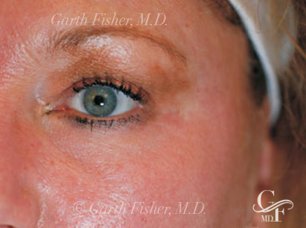 Photo of Patient 06 After Skin/Laser Treatments