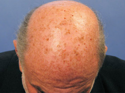 Photo of Patient 07 Before Skin/Laser Treatments