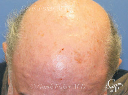 Photo of Patient 07 After Skin/Laser Treatments