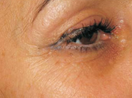 Photo of Patient 16 Before Skin/Laser Treatments