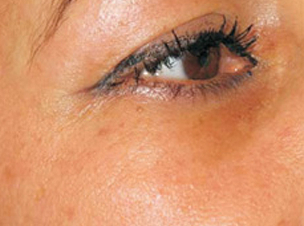 Photo of Patient 16 After Skin/Laser Treatments