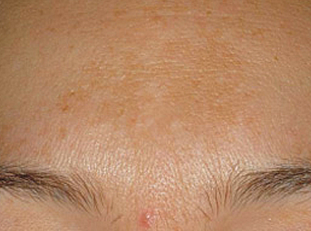 Photo of Patient 17 Before Skin/Laser Treatments
