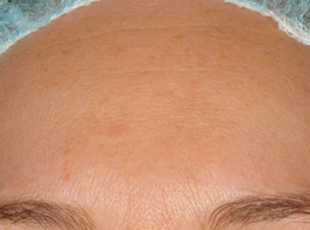 Photo of Patient 17 After Skin/Laser Treatments