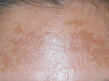 Photo of Patient 18 Before Skin/Laser Treatments