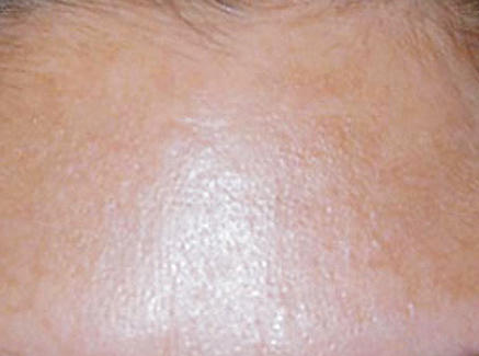 Photo of Patient 18 After Skin/Laser Treatments