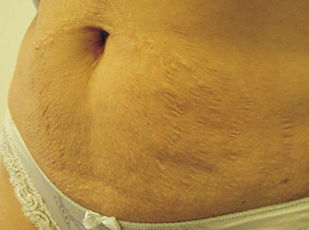 Photo of Patient 29 Before Skin/Laser Treatments