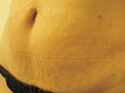 Photo of Patient 29 After Skin/Laser Treatments