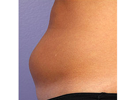 Photo of Patient 01 Before Coolsculpting