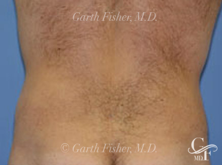 Photo of Patient 01 After Body Contouring