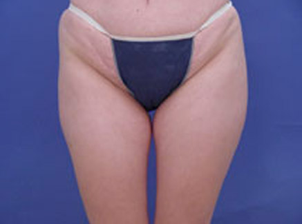 Photo of Patient 03 Before Body Contouring