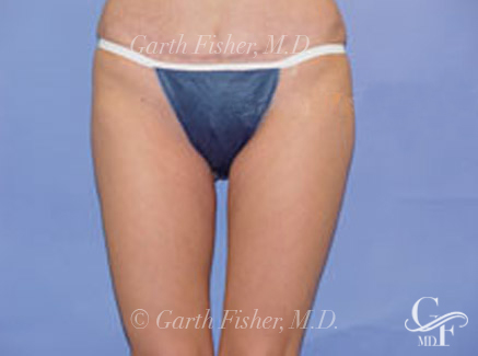 Photo of Patient 03 After Body Contouring