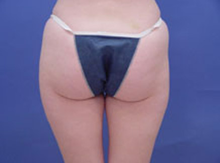 Photo of Patient 03 Before Body Contouring
