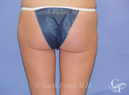 Photo of Patient 03 After Body Contouring