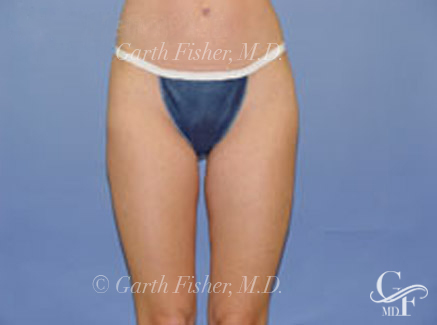 Photo of Patient 05 After Body Contouring