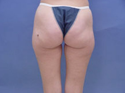 Photo of Patient 05 Before Body Contouring