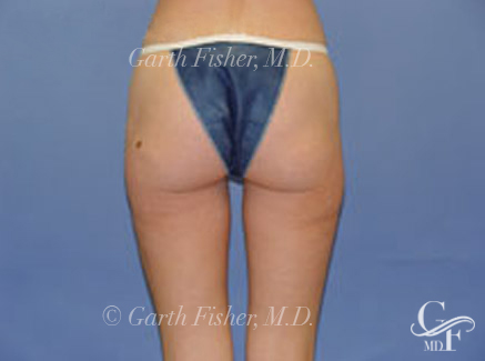 Photo of Patient 05 After Body Contouring