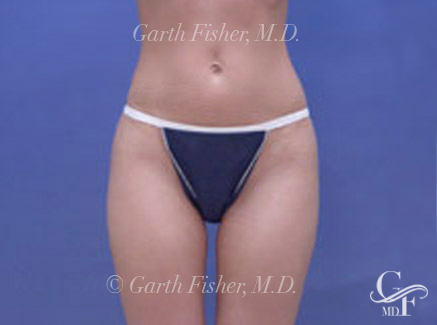 Photo of Patient 07 After Body Contouring