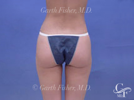 Photo of Patient 07 After Body Contouring