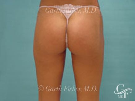 Photo of Patient 08 After Body Contouring