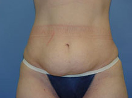 Photo of Patient 01 Before Tummy Tuck