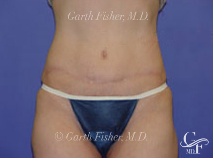 Photo of Patient 01 After Tummy Tuck