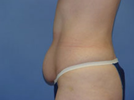 Photo of Patient 01 Before Tummy Tuck