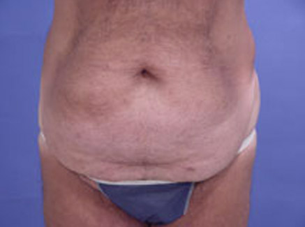 Best Tummy Tuck In California Best Tummy Tuck In California