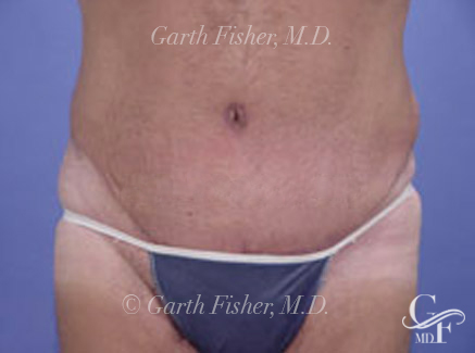 Photo of Patient 02 After Tummy Tuck