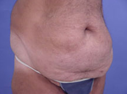 Photo of Patient 02 Before Tummy Tuck
