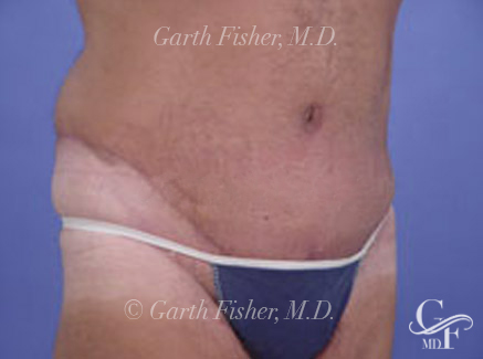 Photo of Patient 02 After Tummy Tuck