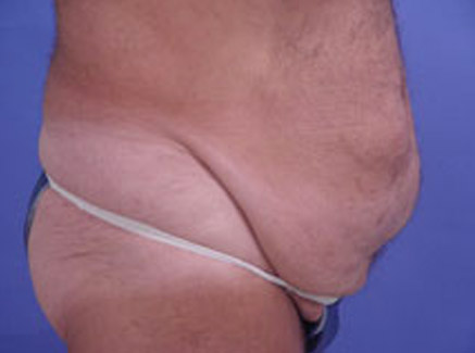 Photo of Patient 02 Before Tummy Tuck