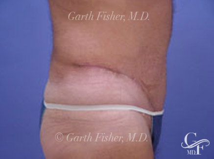 Photo of Patient 02 After Tummy Tuck