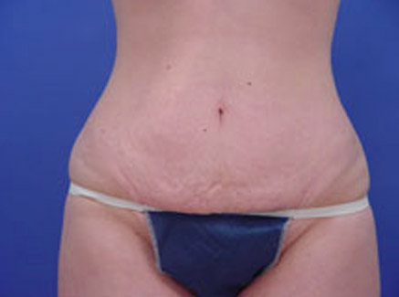 Photo of Patient 03 Before Tummy Tuck