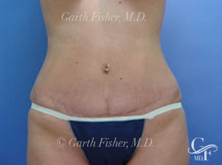 Photo of Patient 03 After Tummy Tuck