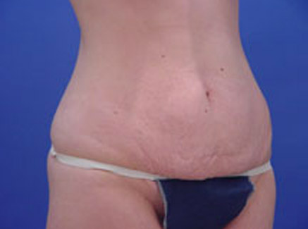 Photo of Patient 03 Before Tummy Tuck