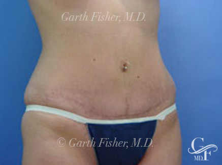 Photo of Patient 03 After Tummy Tuck