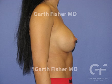 Photo of Patient 01 After Breast Augmentation