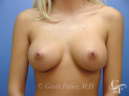 Photo of Patient 02 After Breast Augmentation