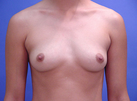 Photo of Patient 04 Before Breast Augmentation
