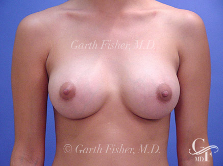 Photo of Patient 04 After Breast Augmentation