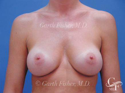 Photo of Patient 05 After Breast Augmentation