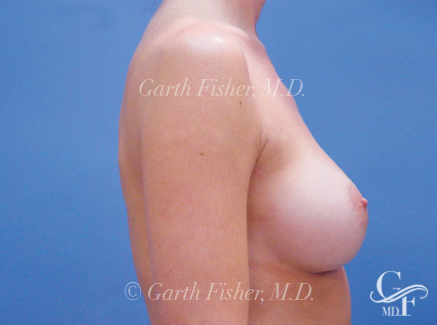 Photo of Patient 05 After Breast Augmentation