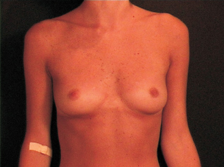 Photo of Patient 06 Before Breast Augmentation