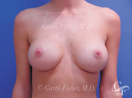 Photo of Patient 06 After Breast Augmentation