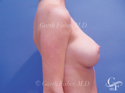Photo of Patient 06 After Breast Augmentation