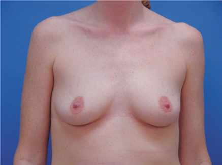 Photo of Patient 07 Before Breast Augmentation