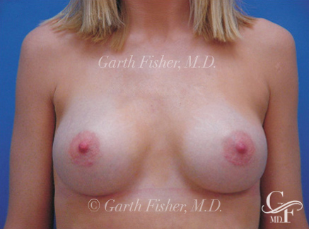 Photo of Patient 07 After Breast Augmentation