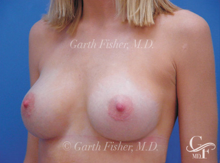 Photo of Patient 07 After Breast Augmentation
